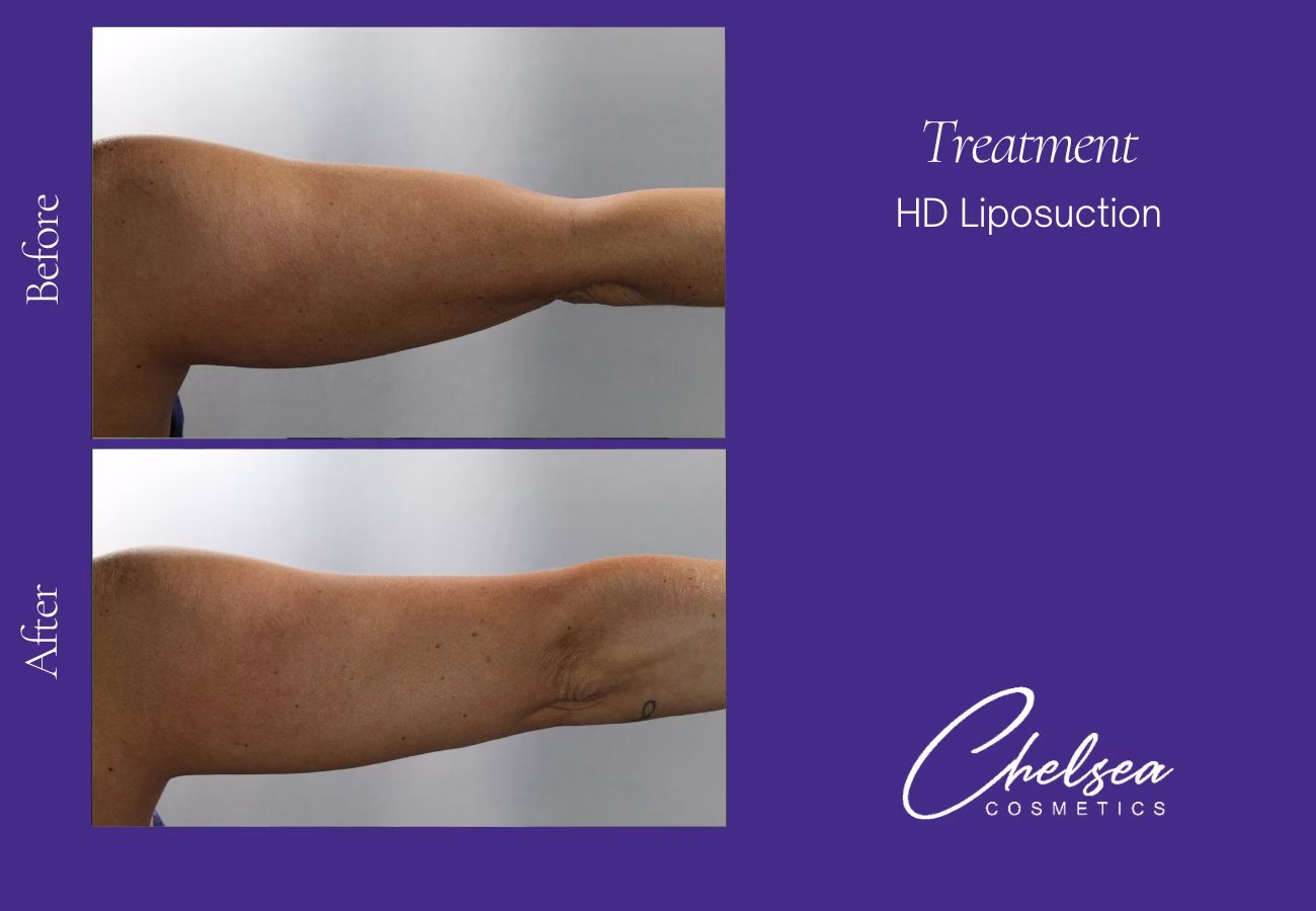 Liposuction before and after results — Chelsea Cosmetics Melbourne