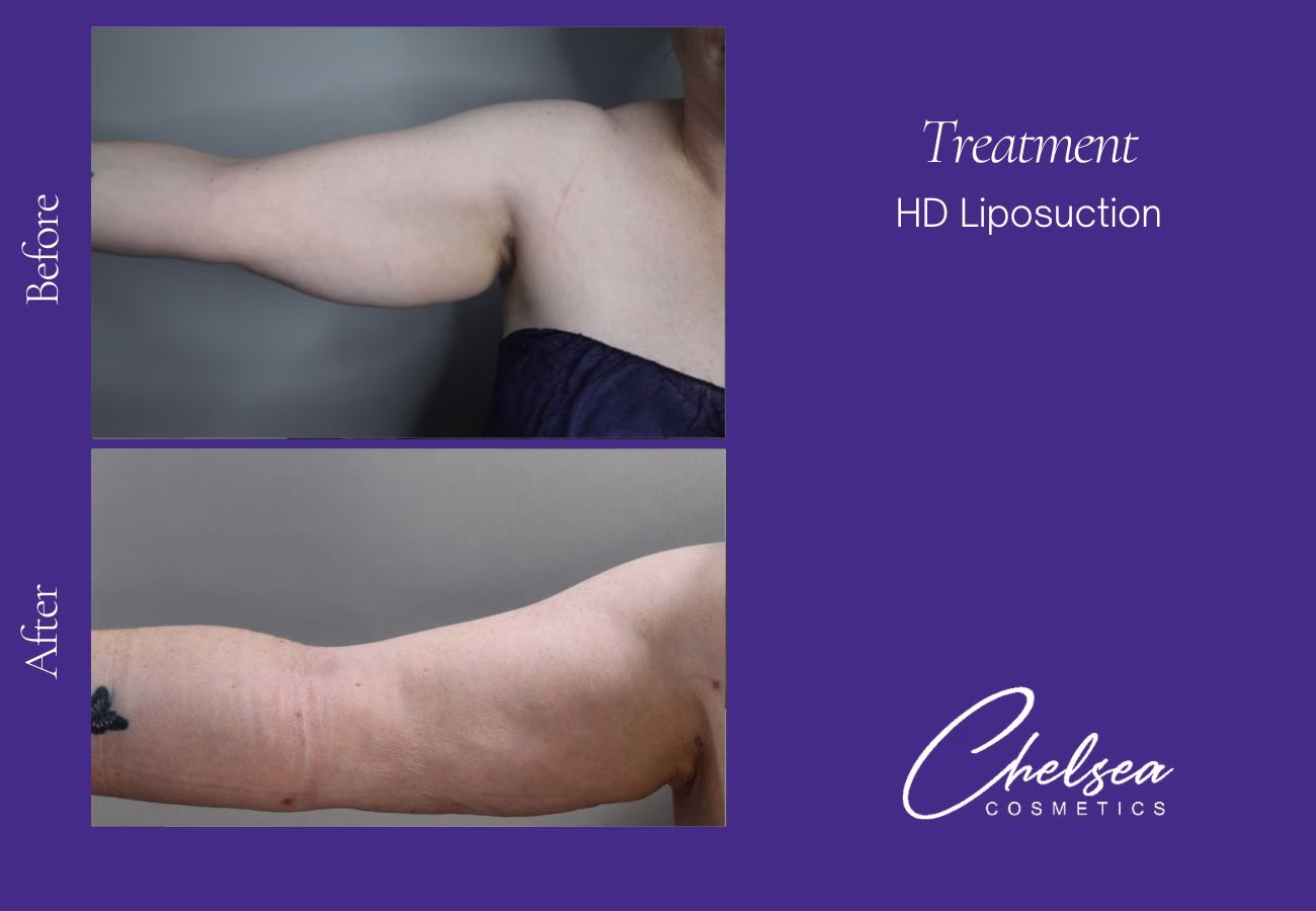 Liposuction before and after results — Chelsea Cosmetics Melbourne