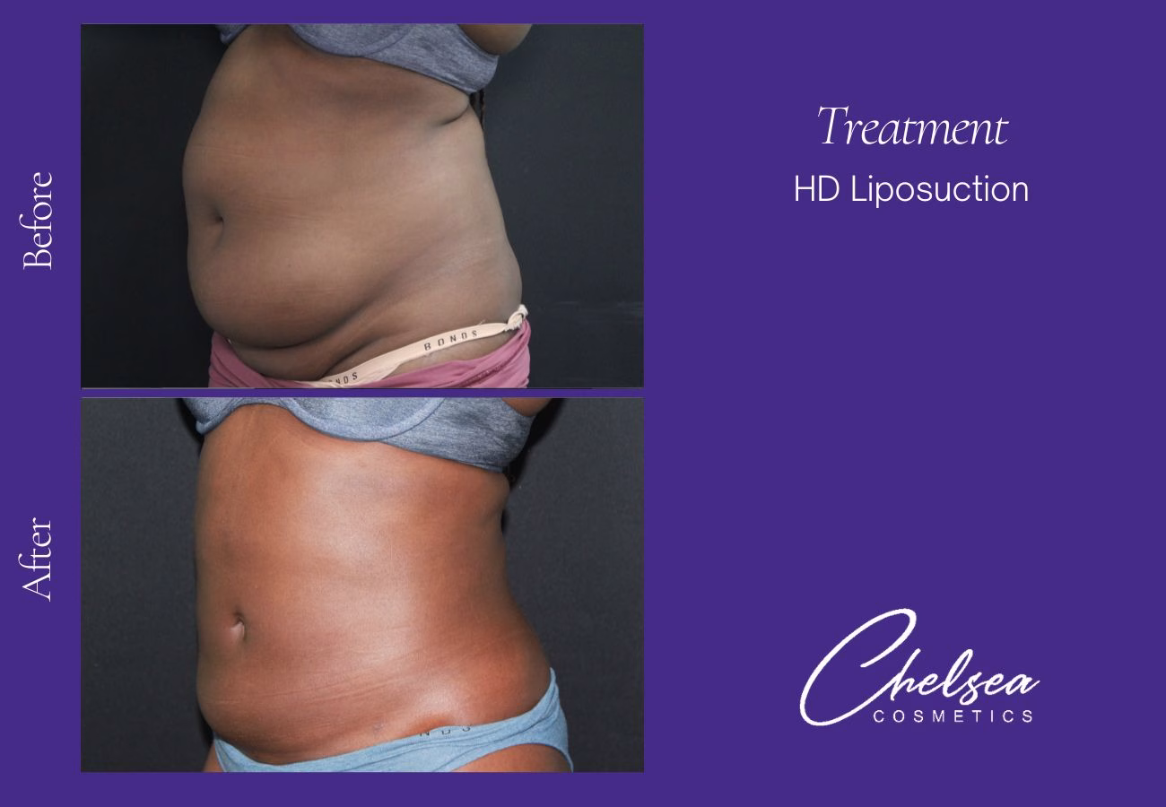 Liposuction — Chelsea Cosmetics Melbourne