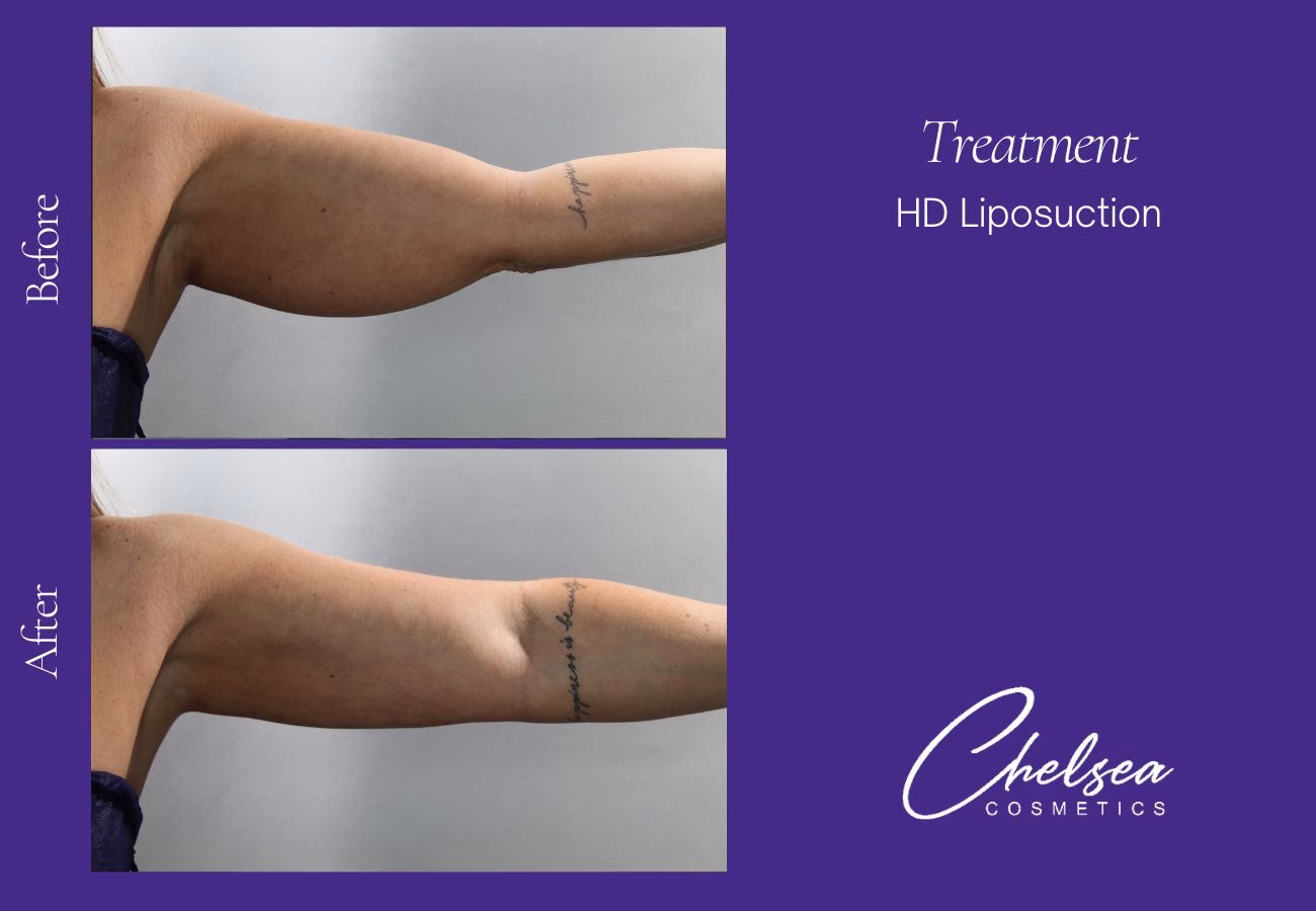 Liposuction — Chelsea Cosmetics Melbourne