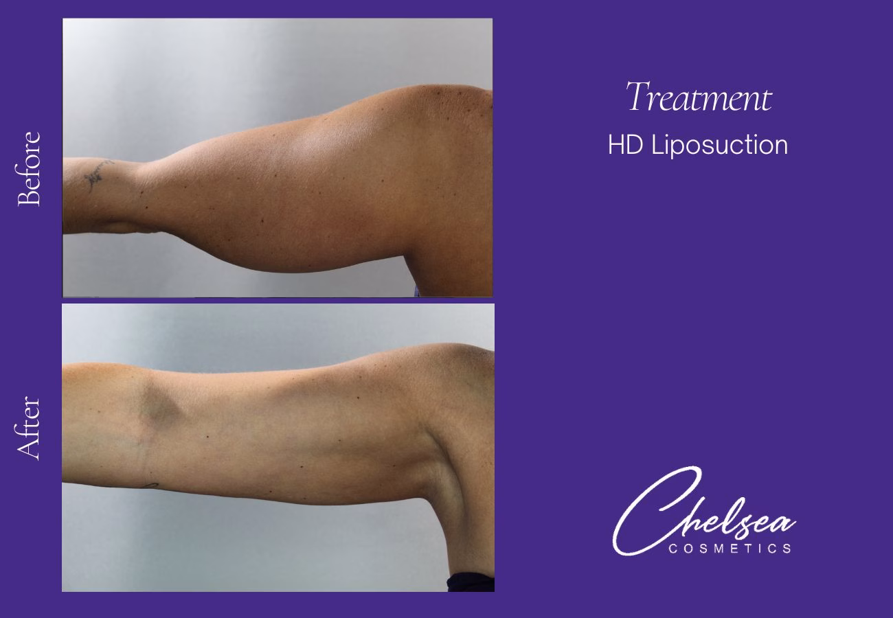 Liposuction — Chelsea Cosmetics Melbourne