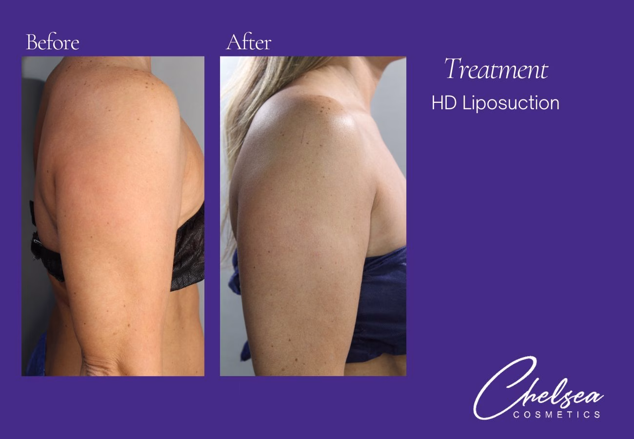 Liposuction — Chelsea Cosmetics Melbourne