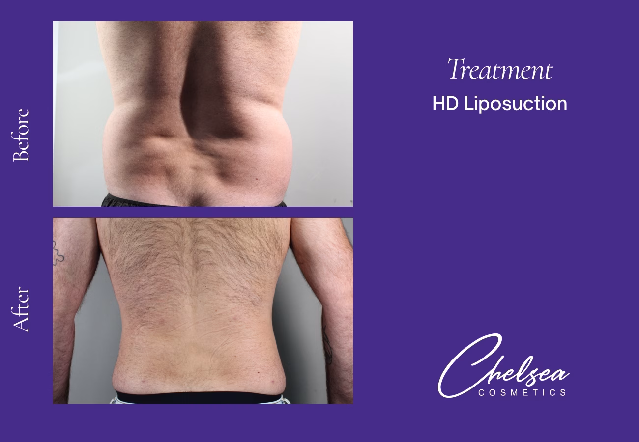 Liposuction before and after results — Chelsea Cosmetics Melbourne