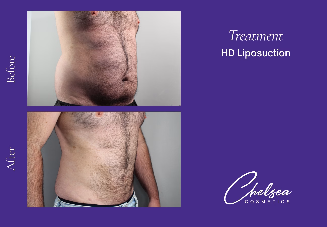 Liposuction — Chelsea Cosmetics Melbourne