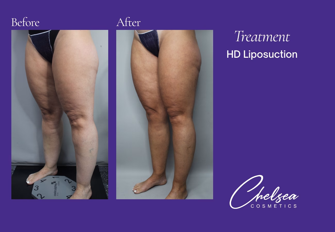 Hd thighs ankles — Chelsea Cosmetics Melbourne
