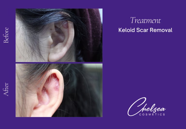 Keloid Scar Removal