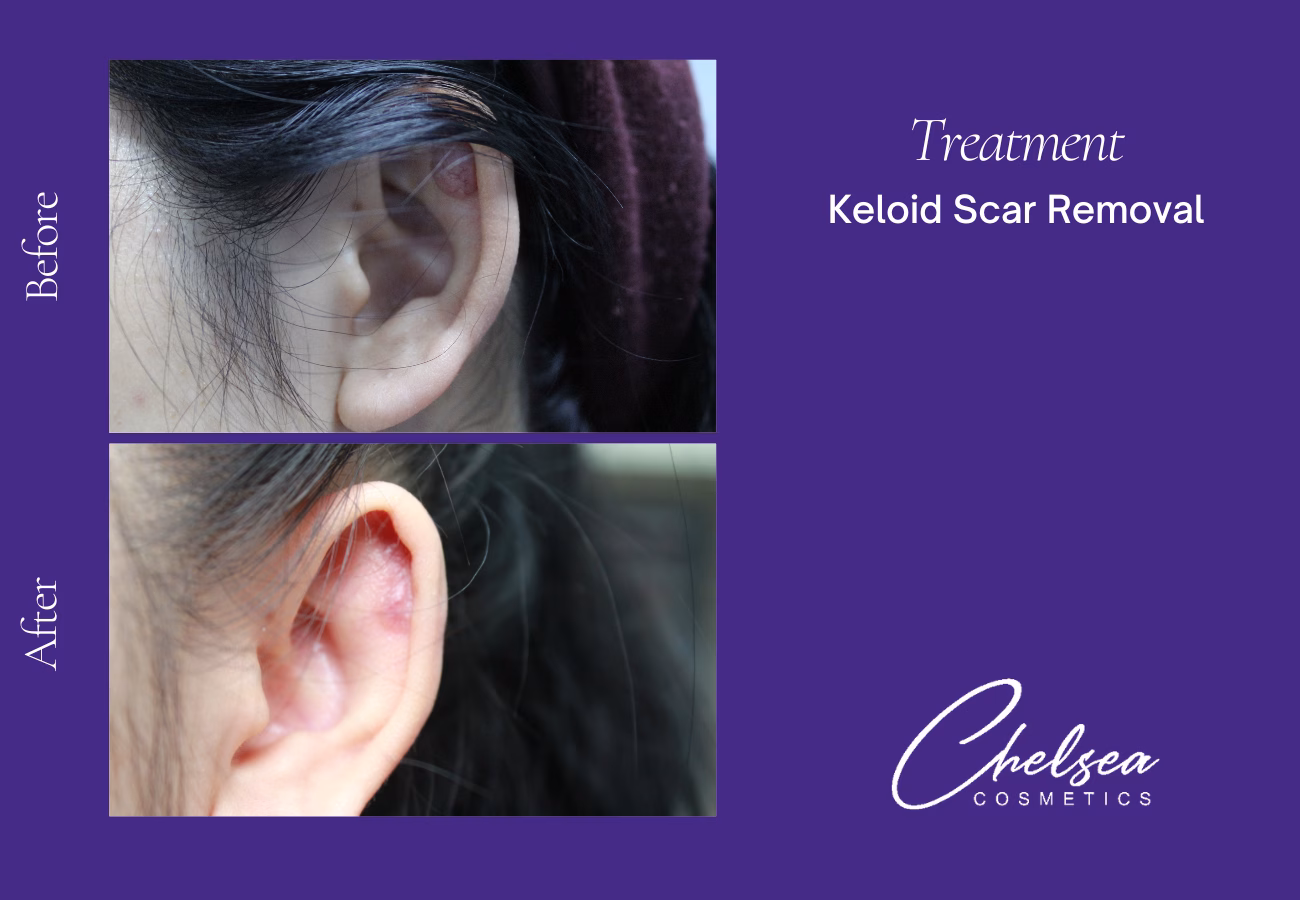 Scar Treatment — Chelsea Cosmetics Melbourne