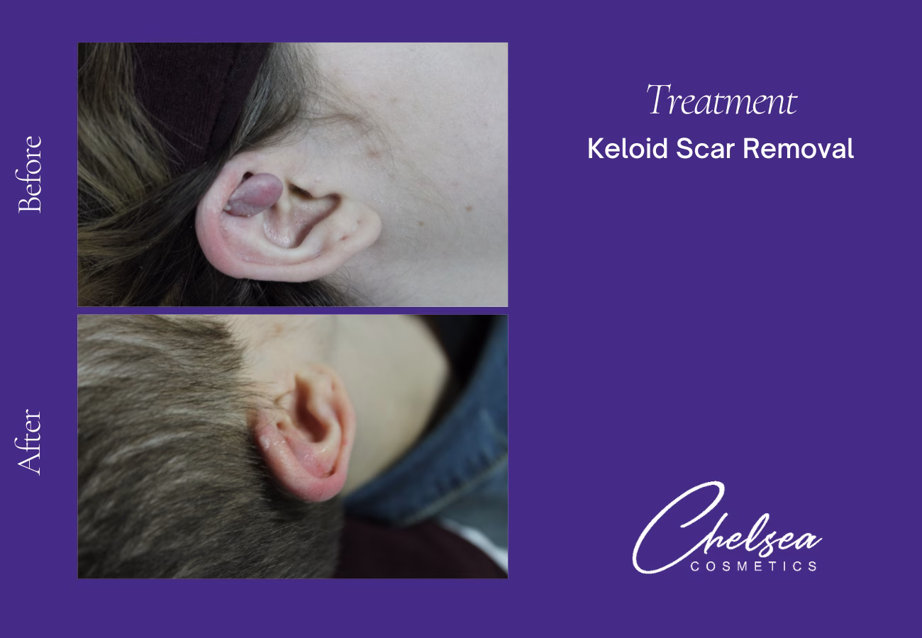 Scar Treatment — Chelsea Cosmetics Melbourne