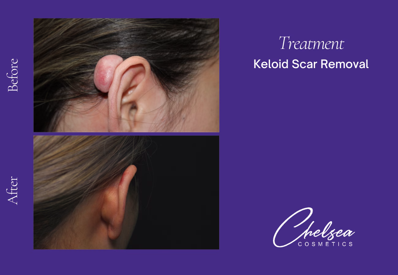 Scar Treatment — Chelsea Cosmetics Melbourne