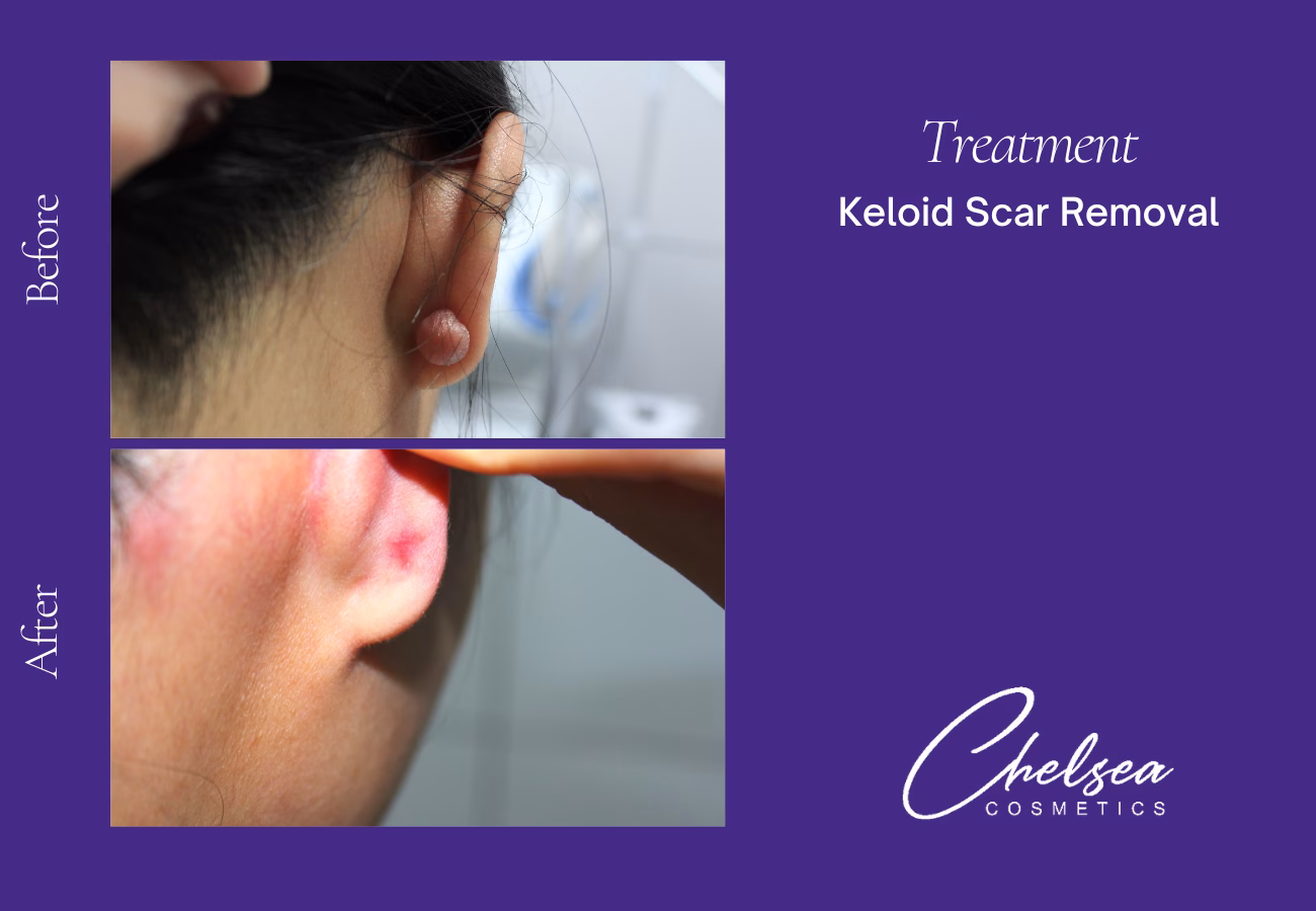 Scar Treatment — Chelsea Cosmetics Melbourne