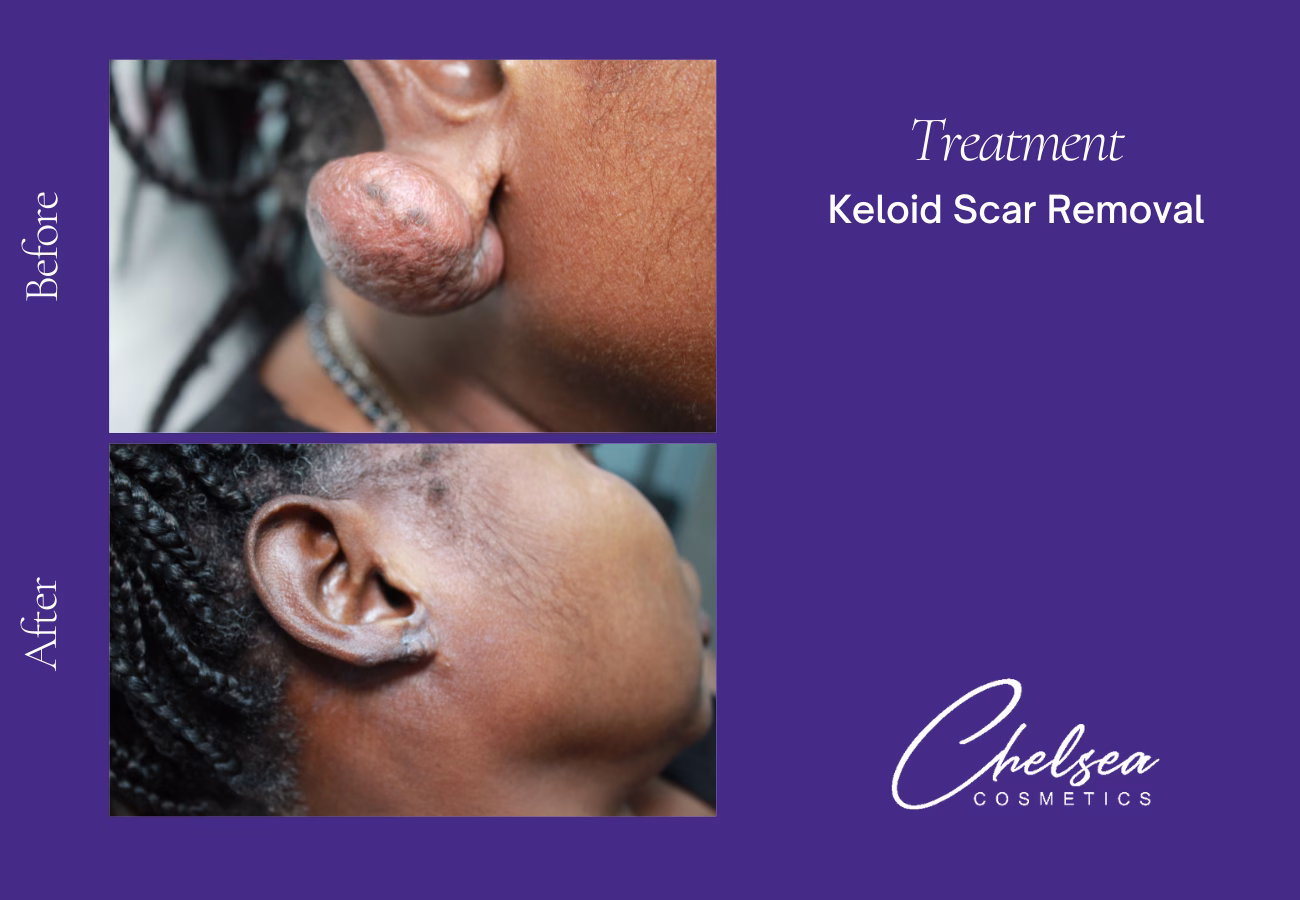 Scar Treatment — Chelsea Cosmetics Melbourne