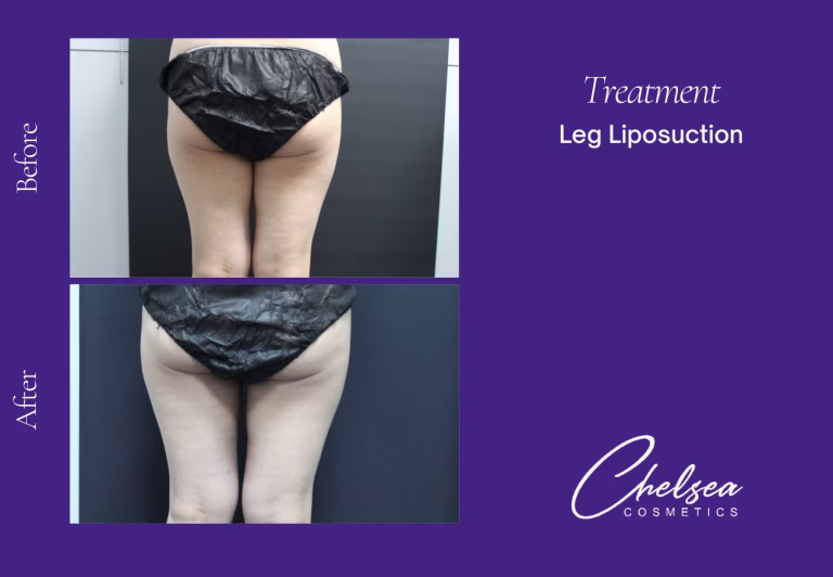 Liposuction — Chelsea Cosmetics Melbourne