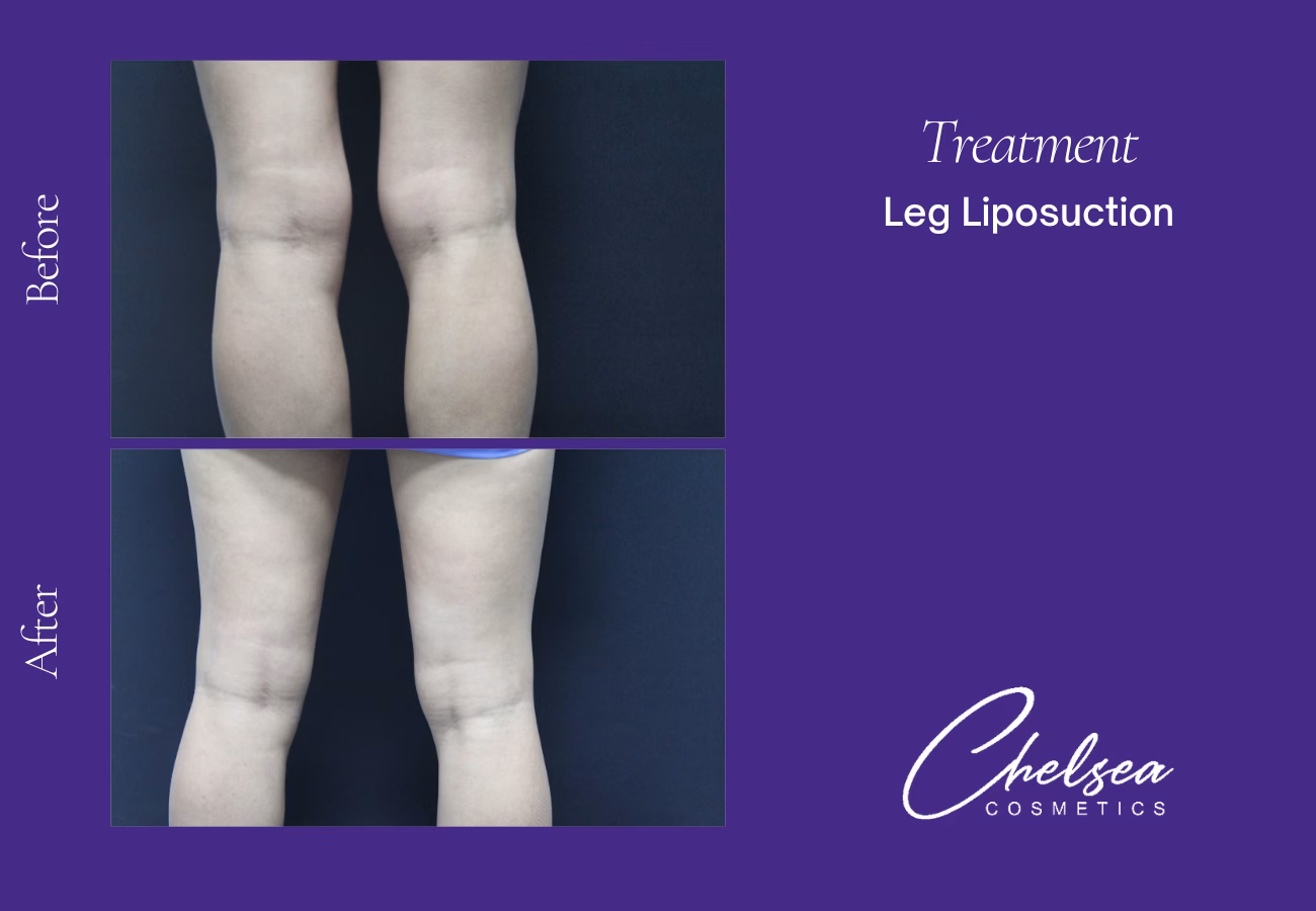 Liposuction — Chelsea Cosmetics Melbourne