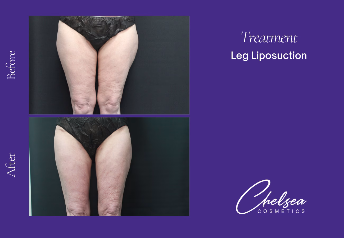 Liposuction — Chelsea Cosmetics Melbourne