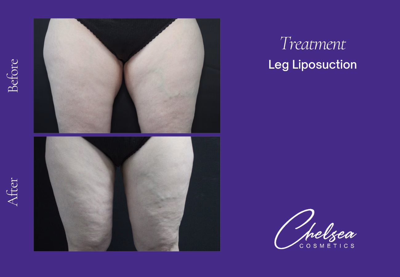 Liposuction — Chelsea Cosmetics Melbourne