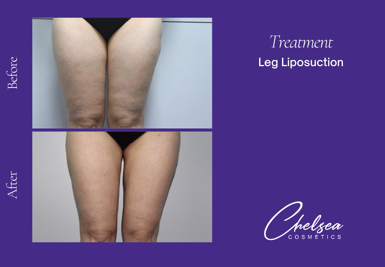 Liposuction — Chelsea Cosmetics Melbourne