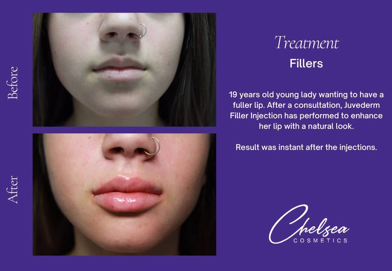 Lip Filler Treatment — Chelsea Cosmetics Melbourne