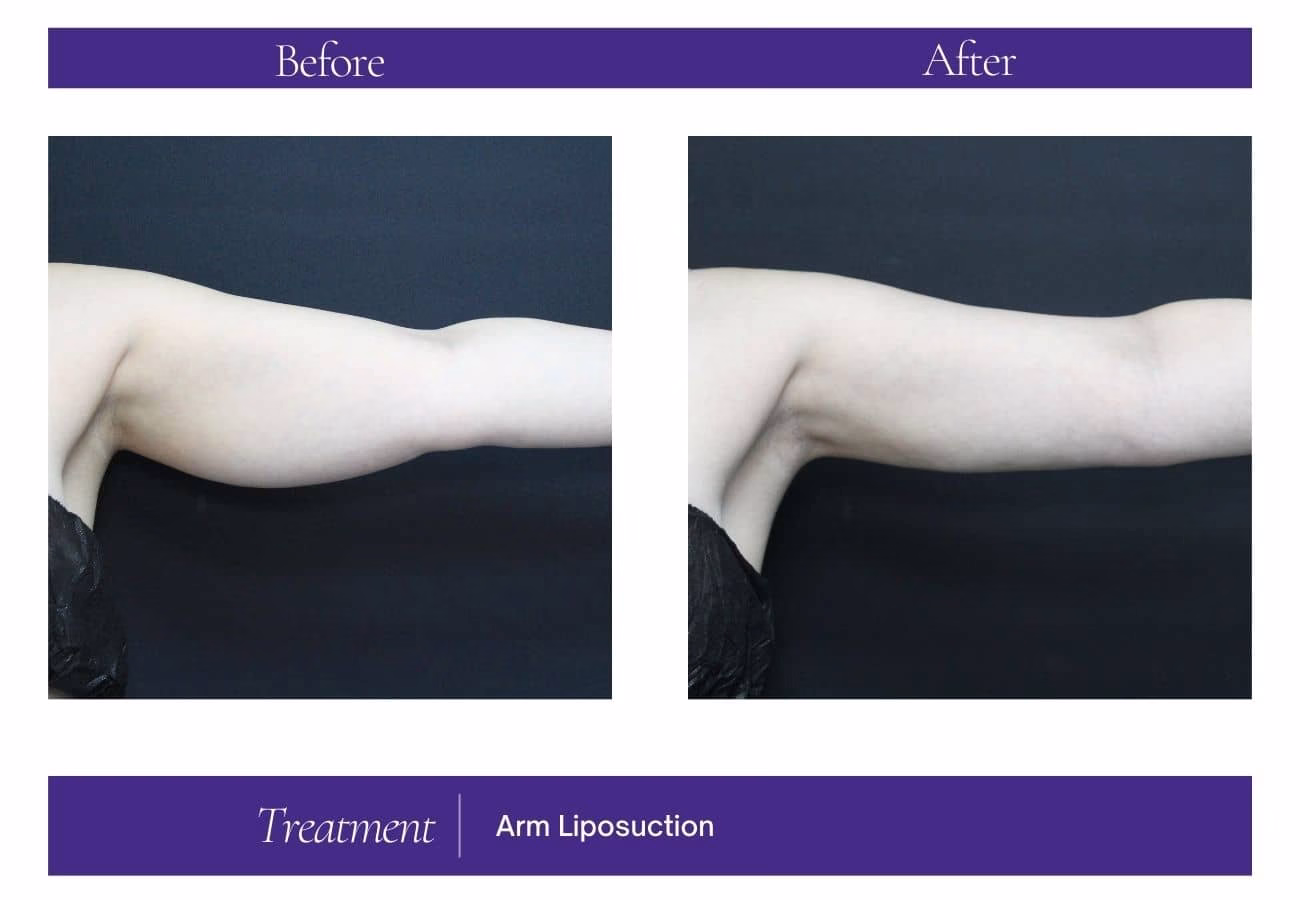 Lipo arms before and after — Chelsea Cosmetics Melbourne