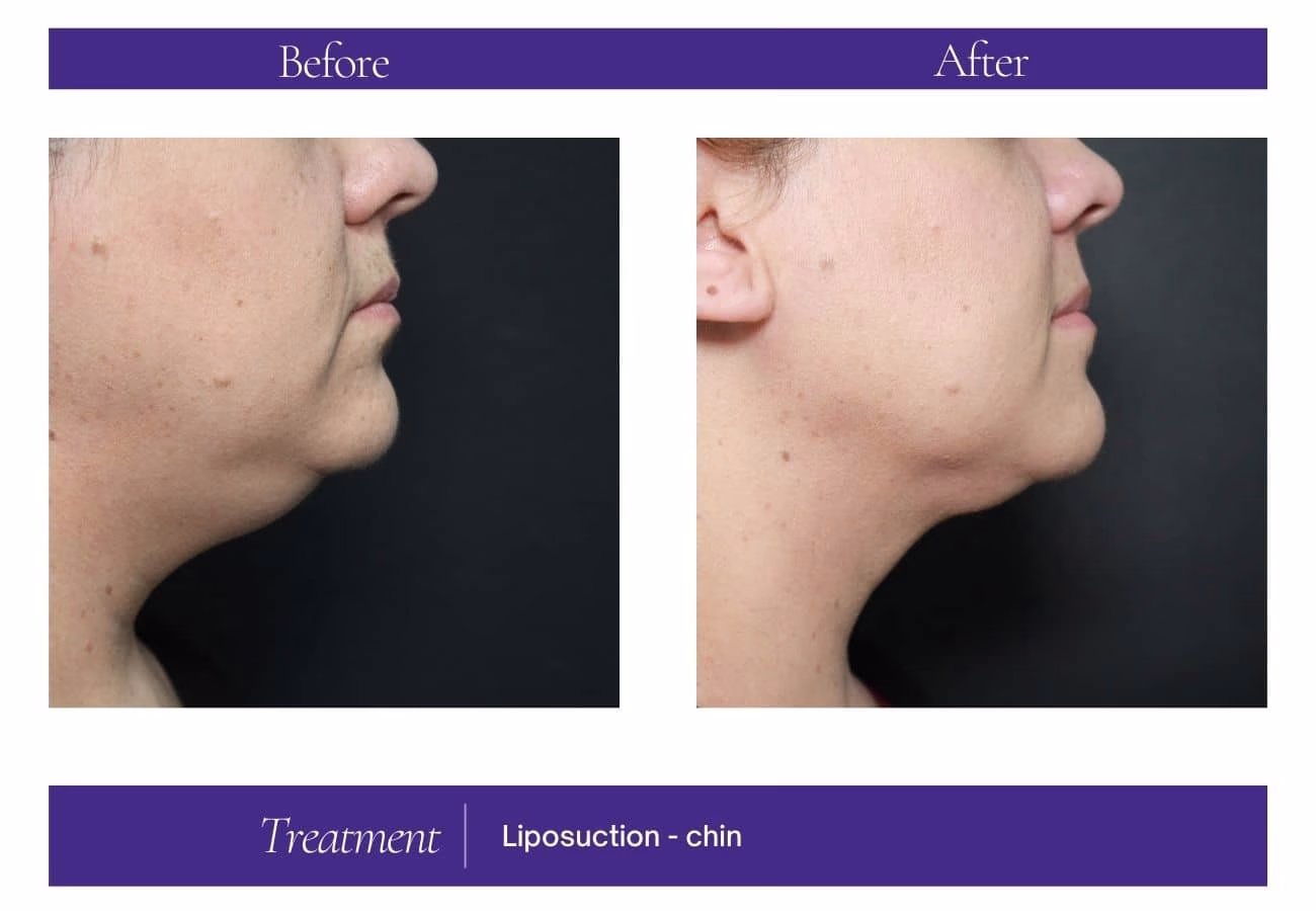 Lipo face before and after — Chelsea Cosmetics Melbourne