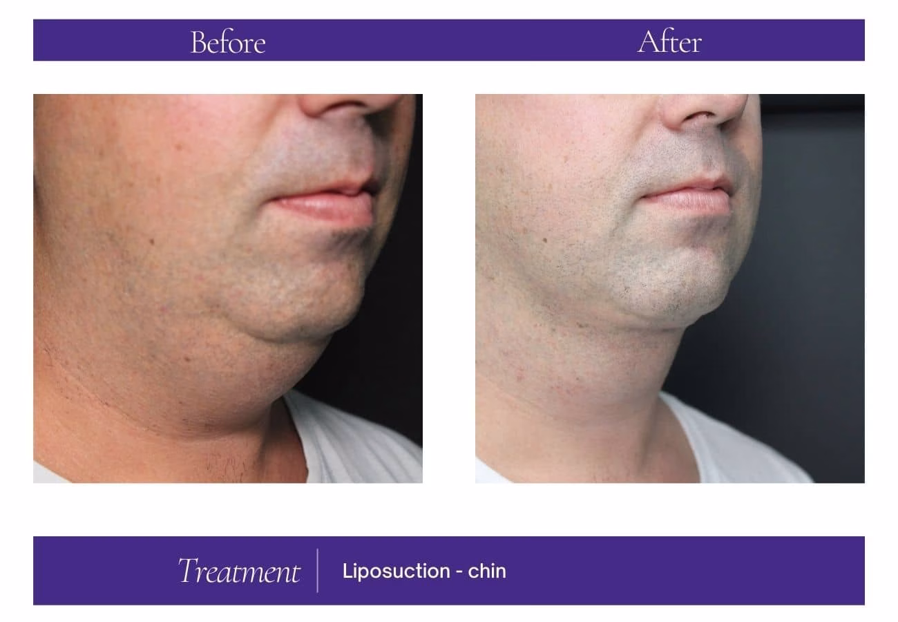 Liposuction — Chelsea Cosmetics Melbourne