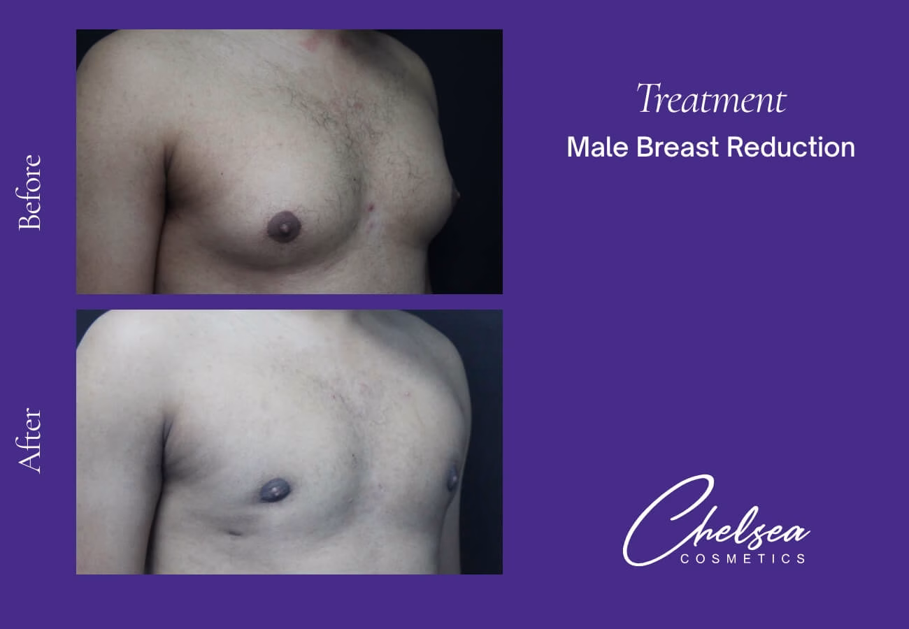 Breast Liposuction Reduction — Chelsea Cosmetics Melbourne