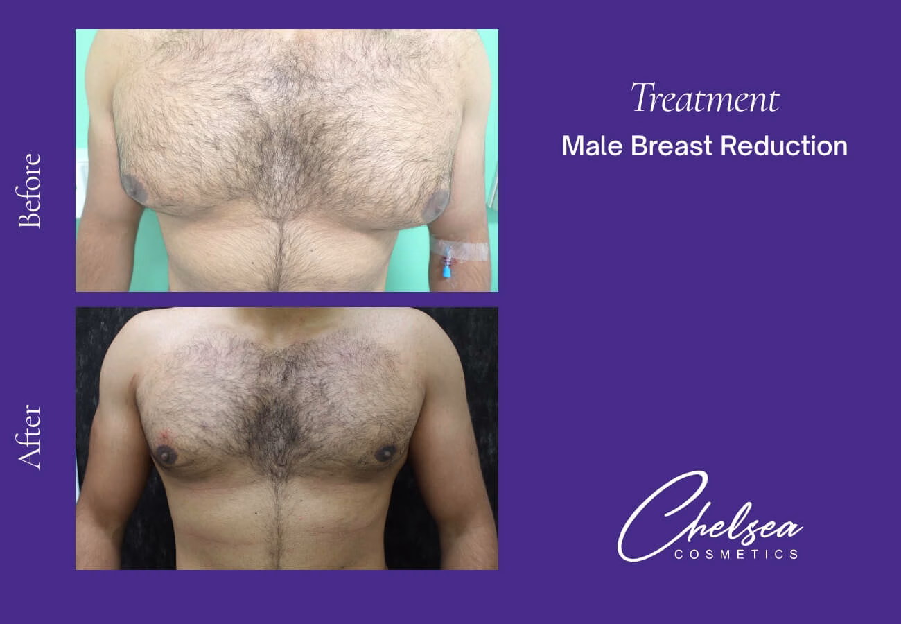 Breast Liposuction Reduction — Chelsea Cosmetics Melbourne