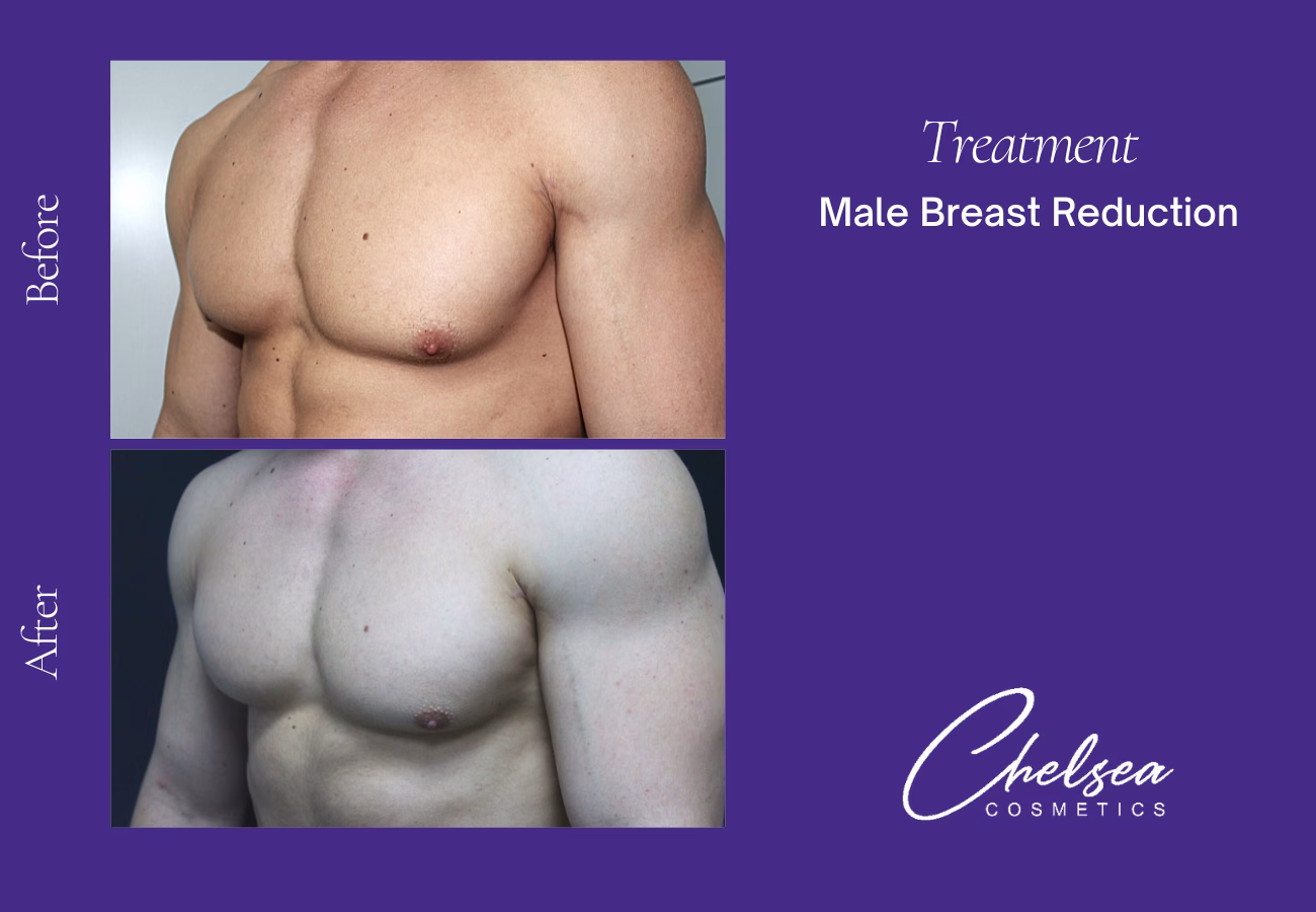 Breast Liposuction Reduction — Chelsea Cosmetics Melbourne