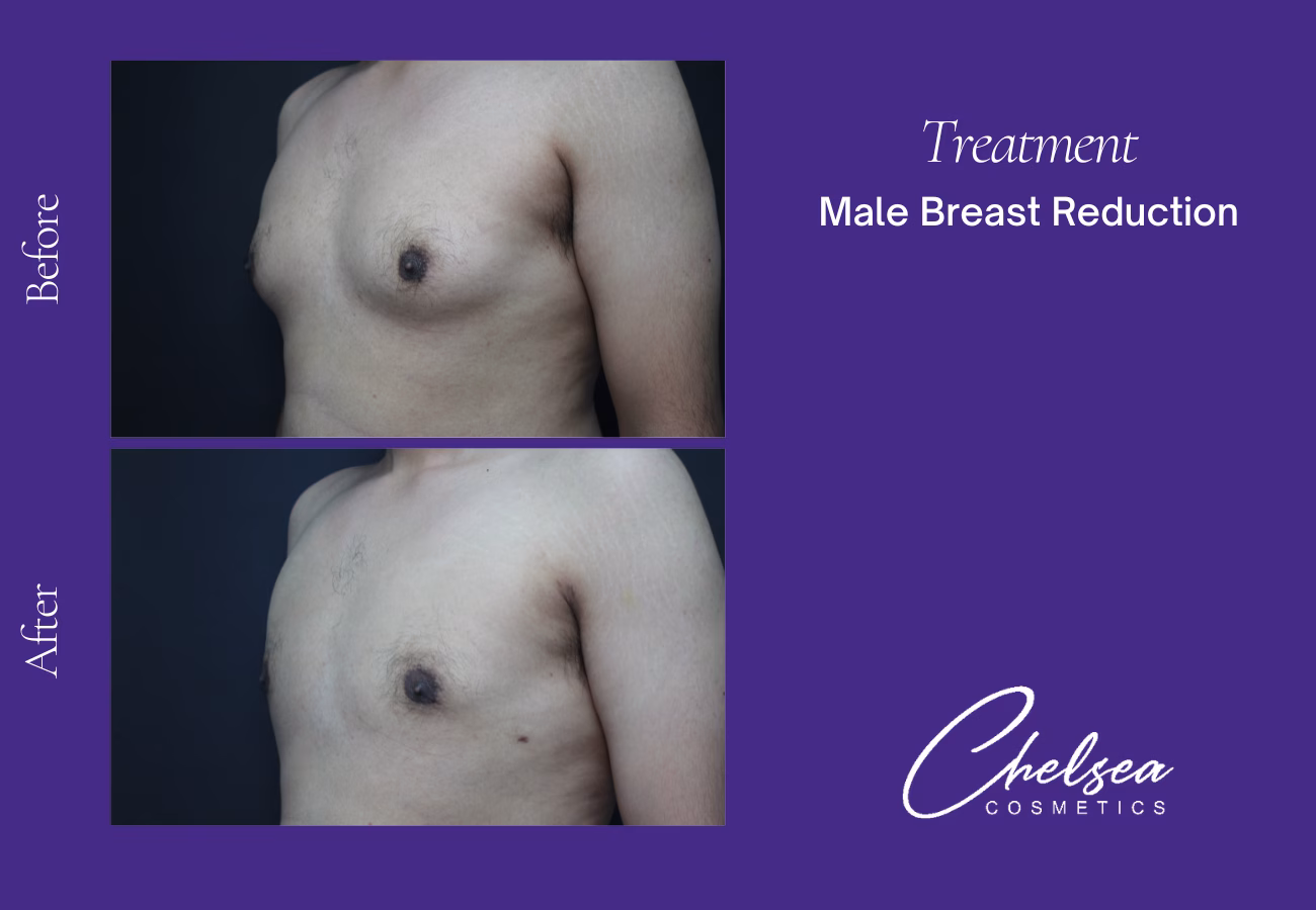 Breast Liposuction Reduction — Chelsea Cosmetics Melbourne