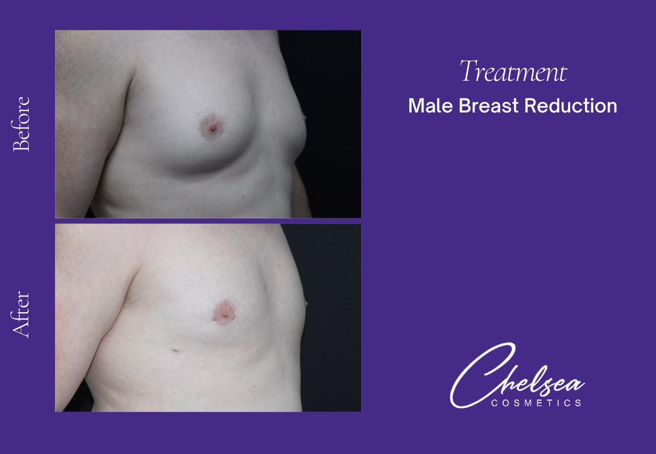 Breast Liposuction Reduction — Chelsea Cosmetics Melbourne
