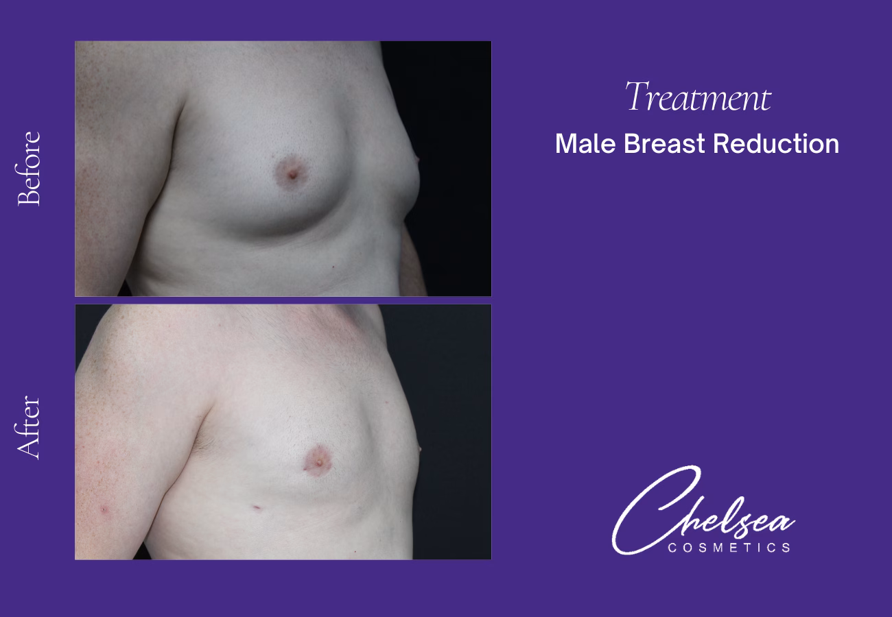Breast Liposuction Reduction — Chelsea Cosmetics Melbourne