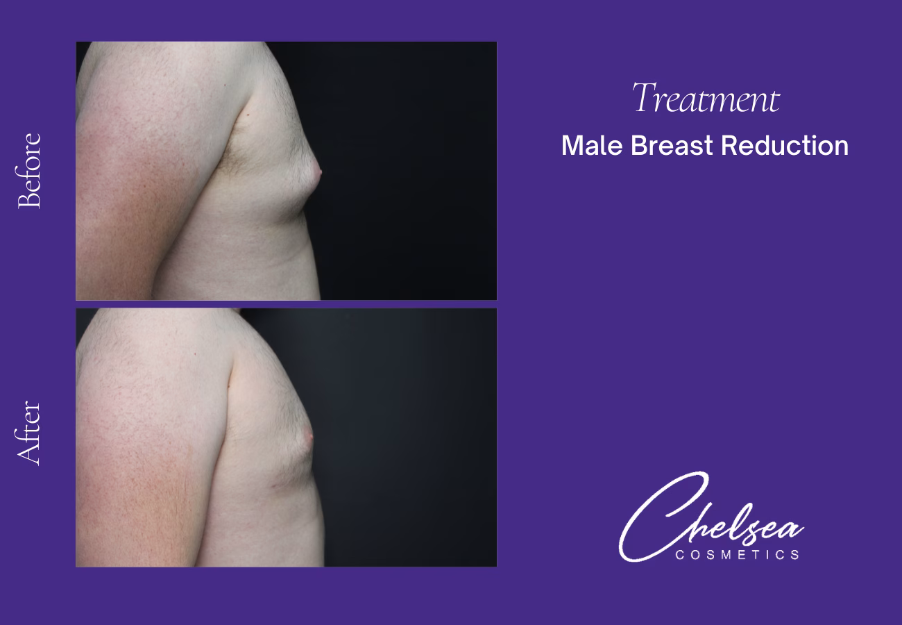 Breast Liposuction Reduction — Chelsea Cosmetics Melbourne
