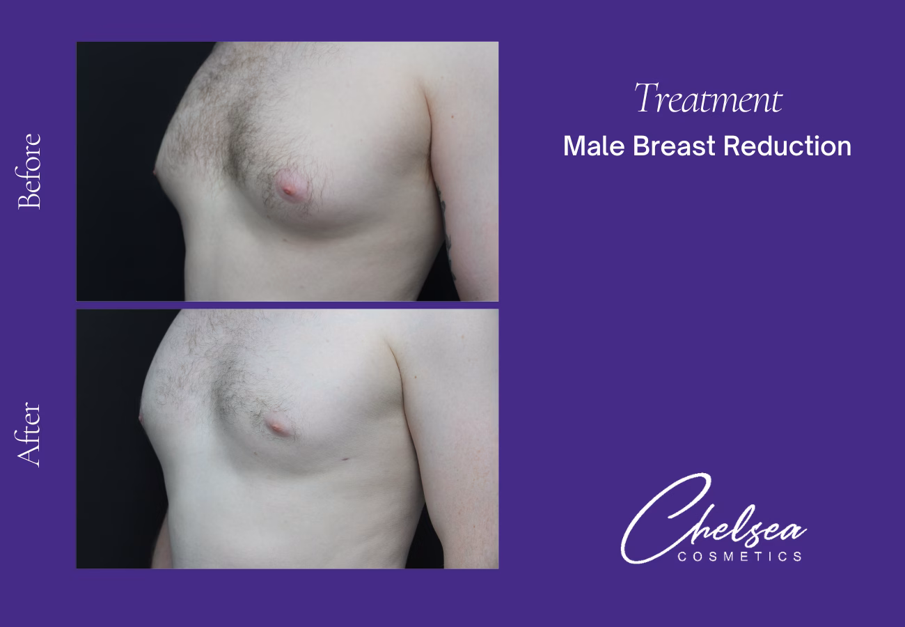 Breast Liposuction Reduction — Chelsea Cosmetics Melbourne