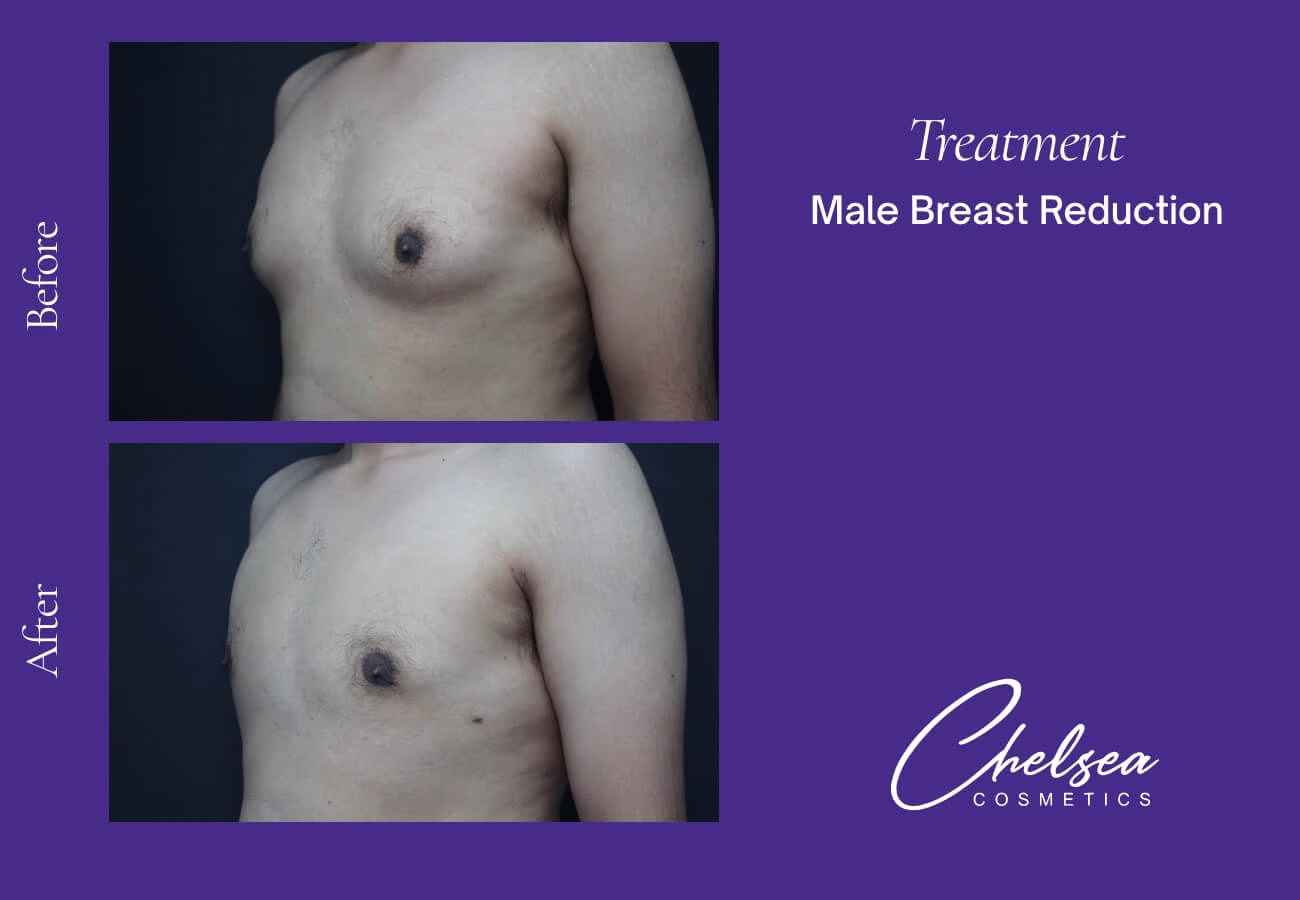 Breast Liposuction Reduction — Chelsea Cosmetics Melbourne