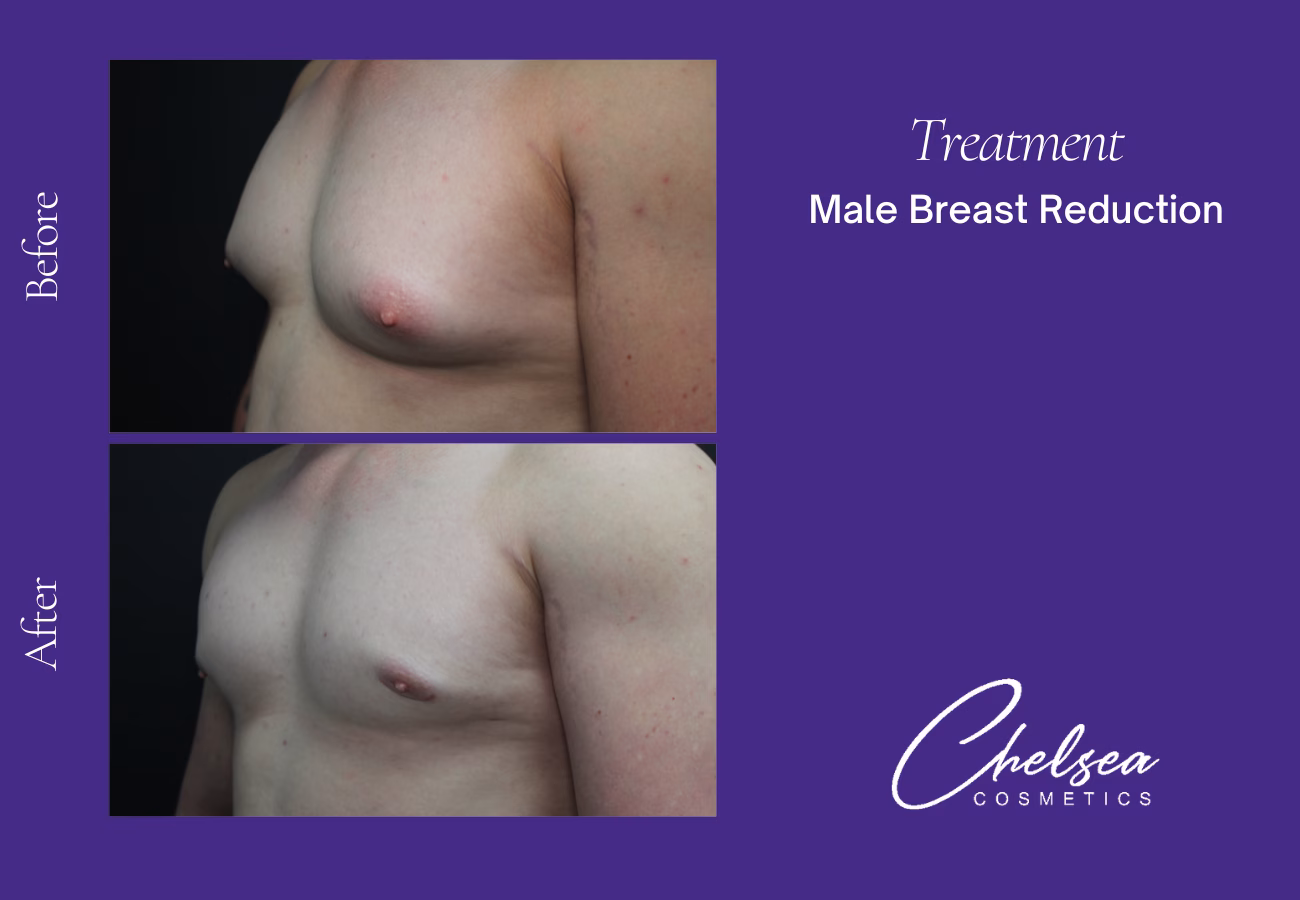Breast Liposuction Reduction — Chelsea Cosmetics Melbourne
