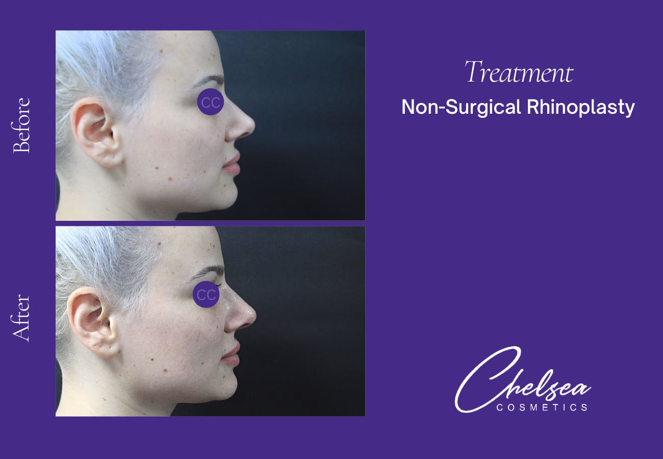 Rhinoplasty — Chelsea Cosmetics Melbourne
