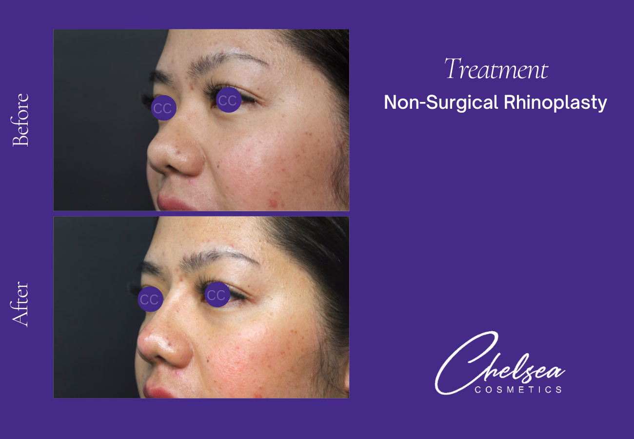 Rhinoplasty — Chelsea Cosmetics Melbourne