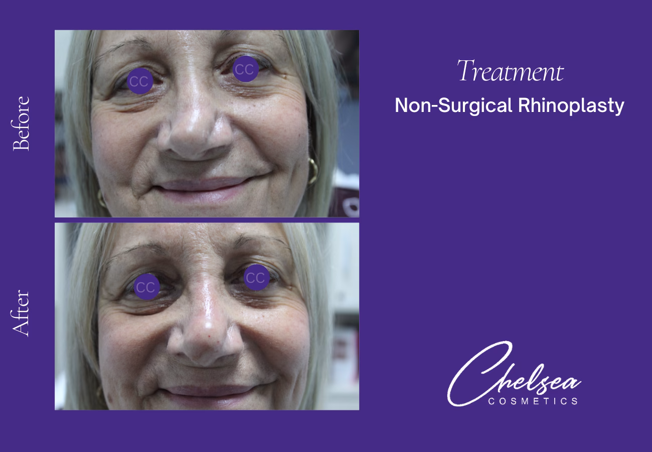Rhinoplasty — Chelsea Cosmetics Melbourne