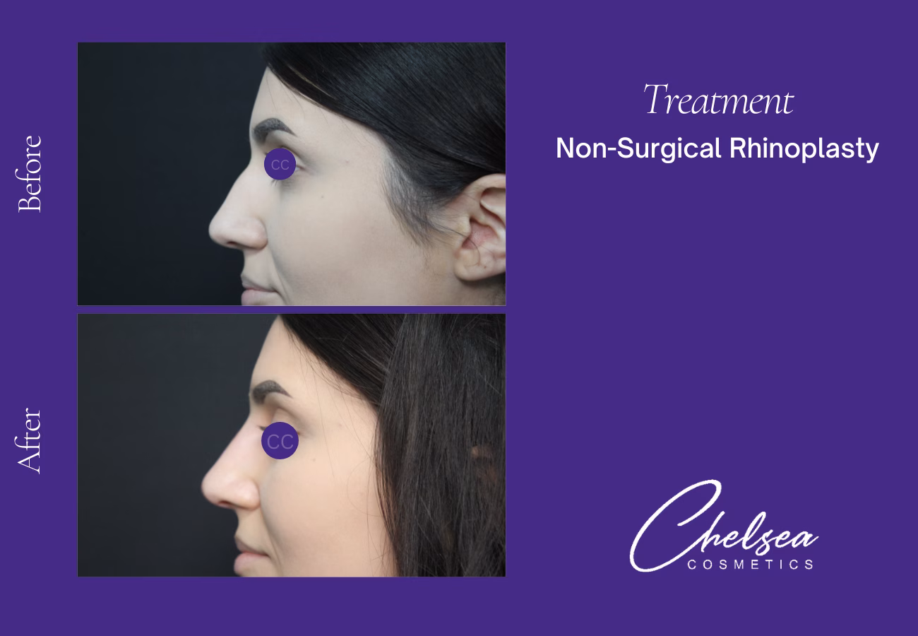 Rhinoplasty — Chelsea Cosmetics Melbourne