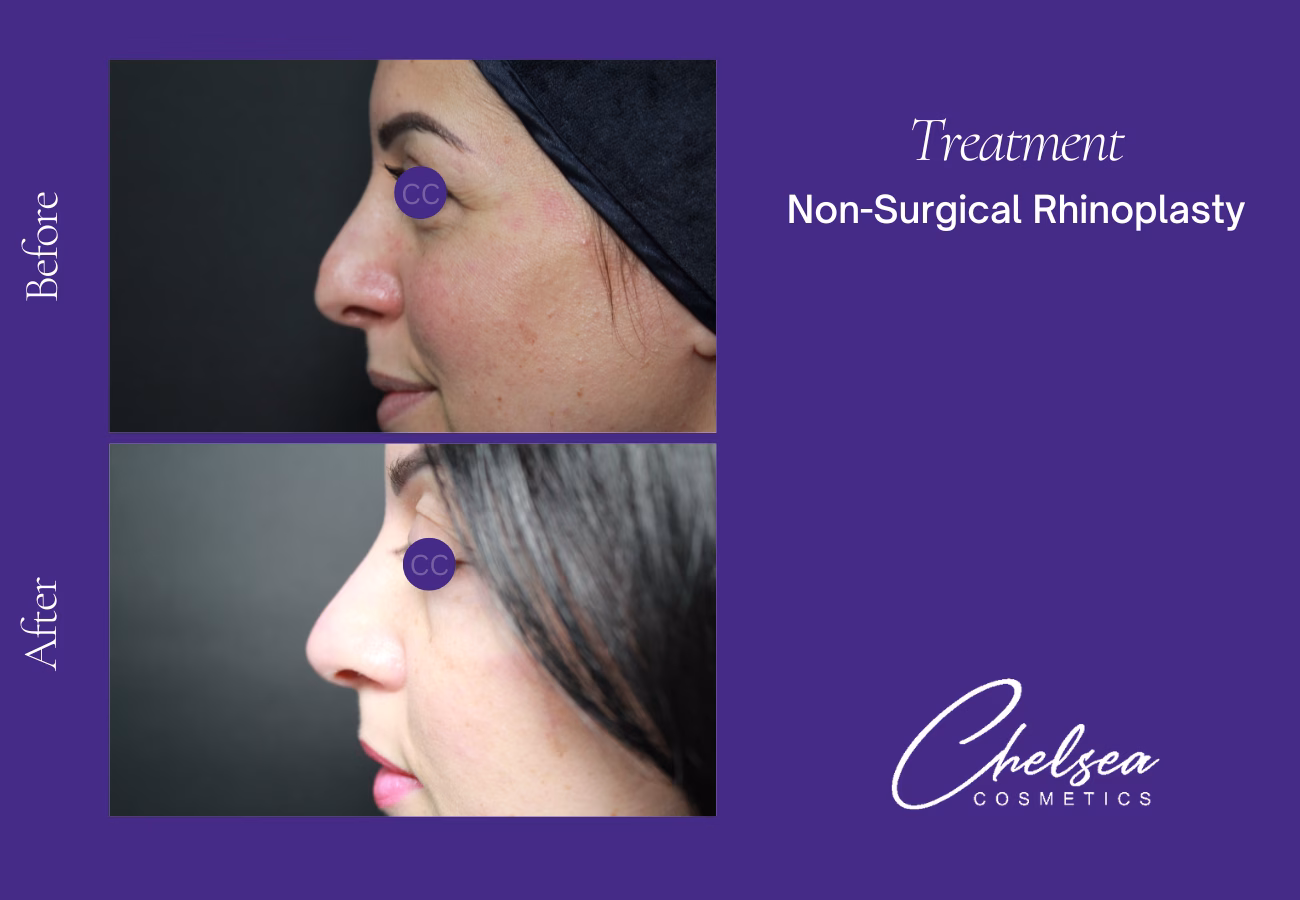 Rhinoplasty — Chelsea Cosmetics Melbourne