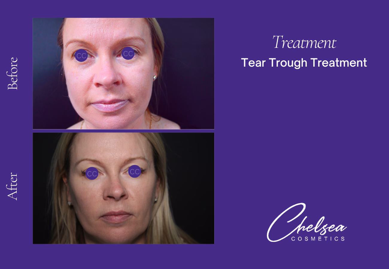 Tear through treatment — Chelsea Cosmetics Melbourne