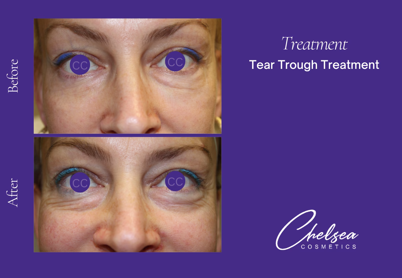 Tear through treatment — Chelsea Cosmetics Melbourne
