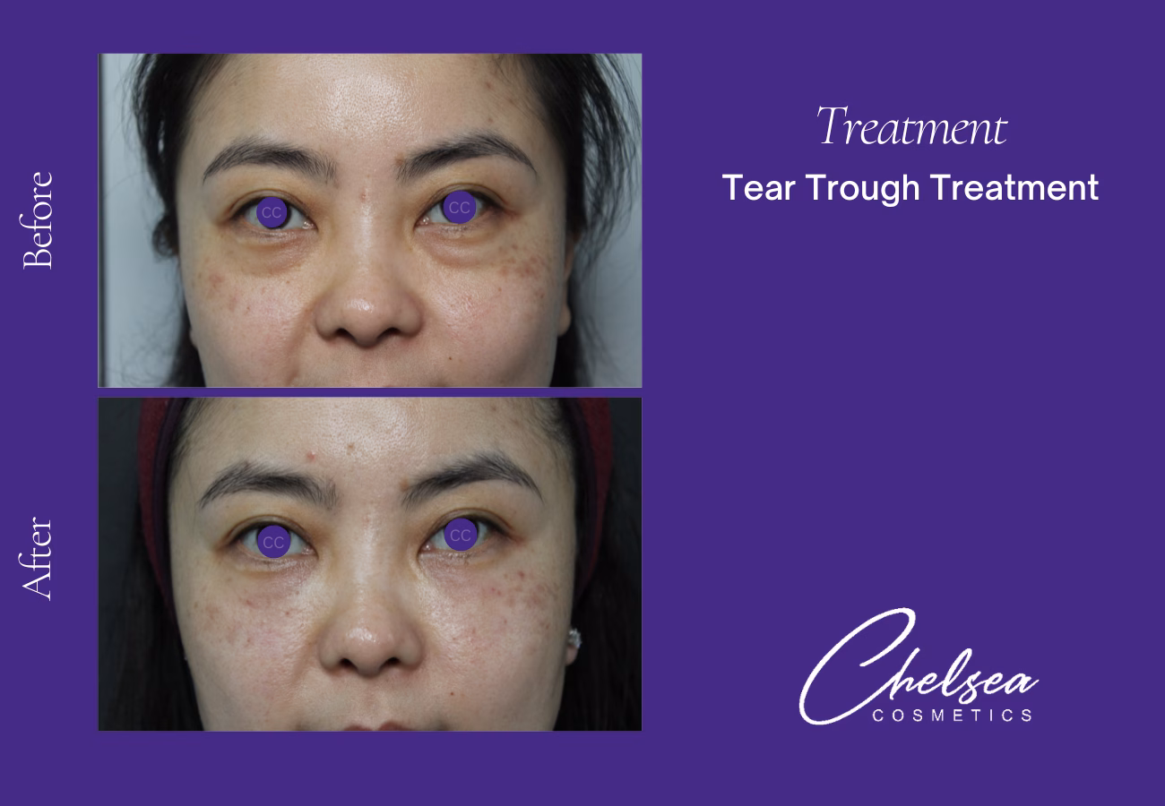 Tear through treatment — Chelsea Cosmetics Melbourne