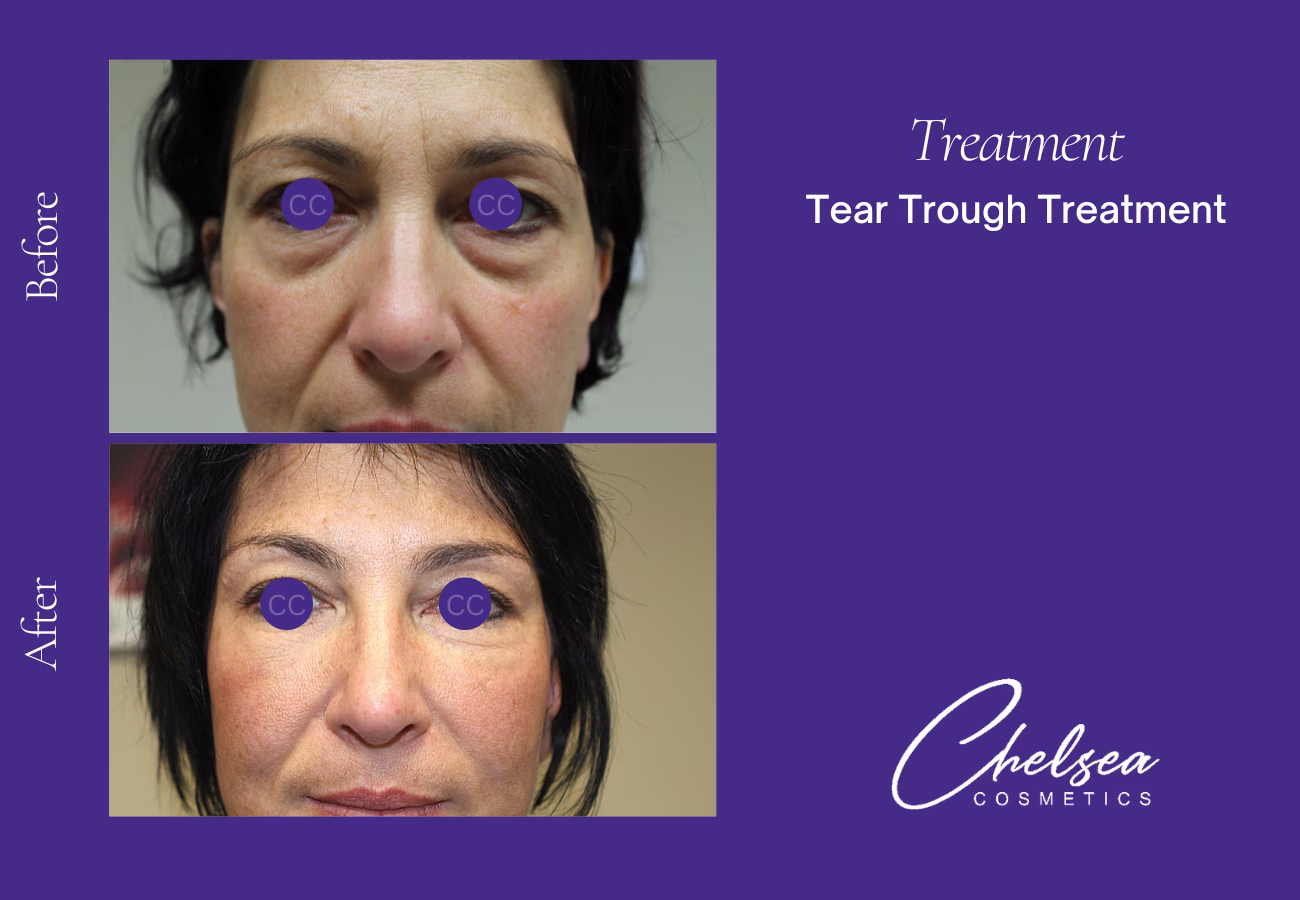 Tear through treatment — Chelsea Cosmetics Melbourne