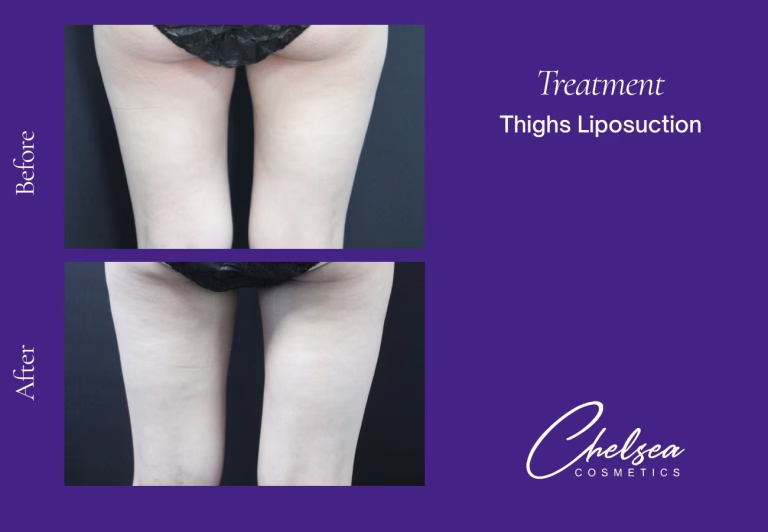 Liposuction before and after results — Chelsea Cosmetics Melbourne