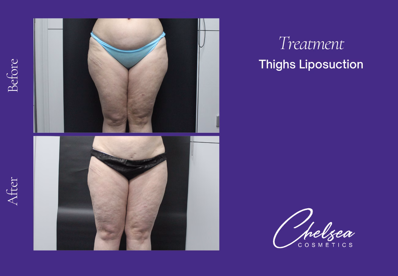 Liposuction — Chelsea Cosmetics Melbourne