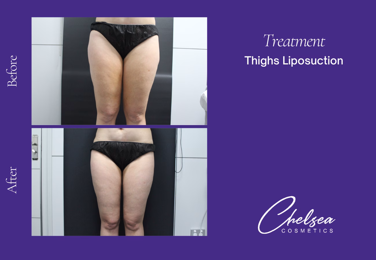 Liposuction — Chelsea Cosmetics Melbourne