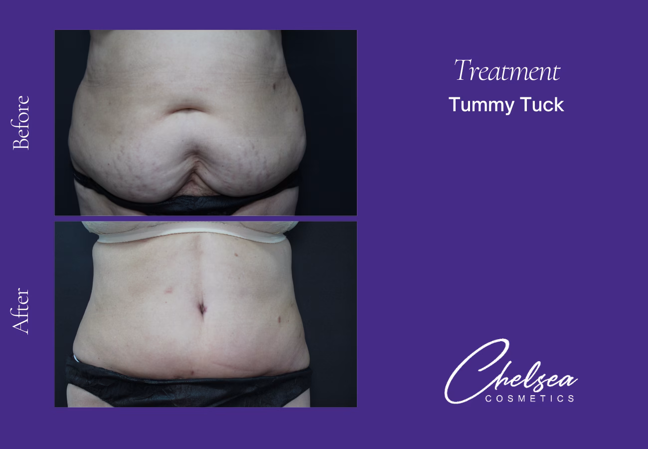 Tummy Tuck (Abdominoplasty) — Chelsea Cosmetics Melbourne