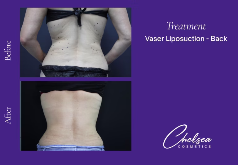 VASER Liposuction before and after results — Chelsea Cosmetics Melbourne