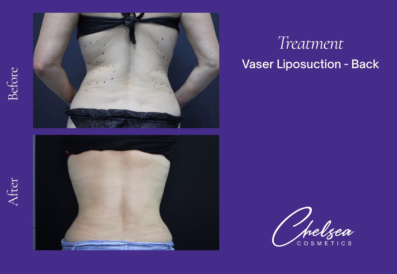 VASER Liposuction before and after results — Chelsea Cosmetics Melbourne