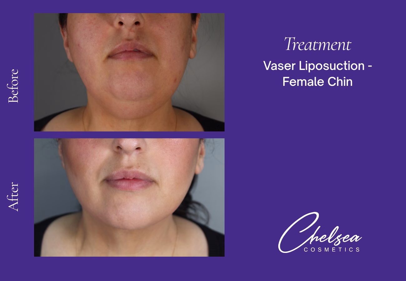 Chin Treatment — Chelsea Cosmetics Melbourne